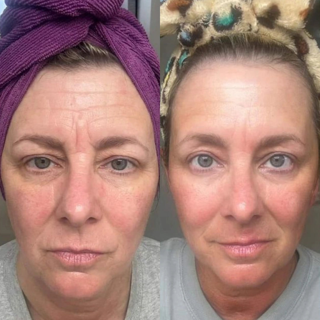 EyePods® 2-in-1 Red Light Therapy + EMS To Erase Eye Bags