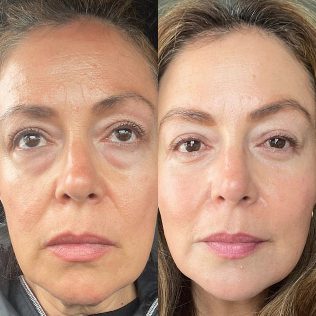 EyePods® 2-in-1 Red Light Therapy + EMS To Erase Eye Bags