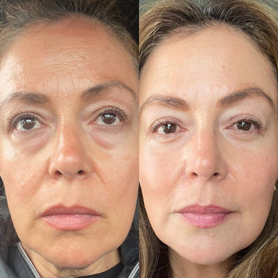 EyePods® 2-in-1 Red Light Therapy + EMS To Erase Eye Bags